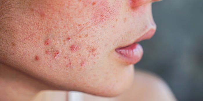 image of a person with acne