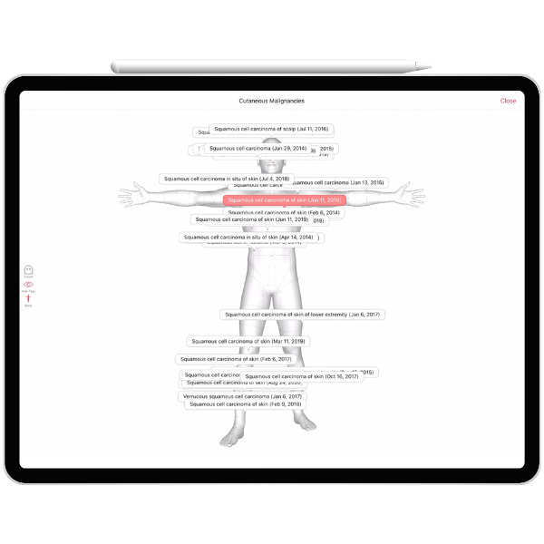 malignancy monitoring over time